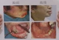 全球罕見 因帶狀皰疹下顎骨壞死-醫護新鮮事